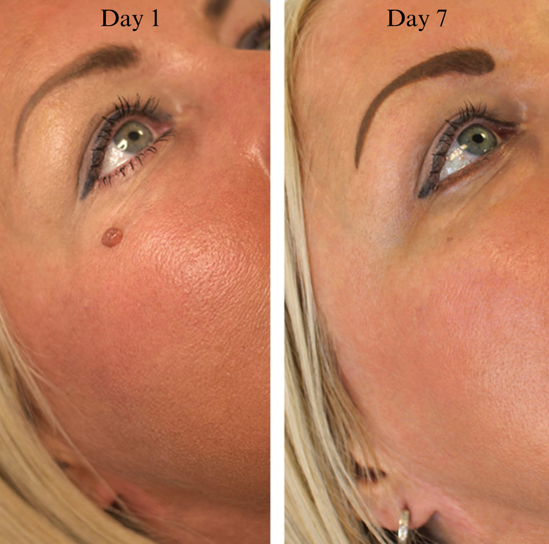 Skin Tag Removal Kit