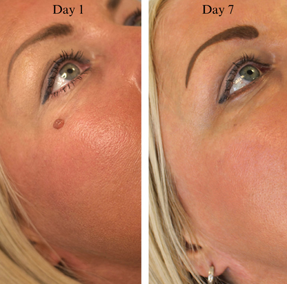 Skin Tag Removal Kit