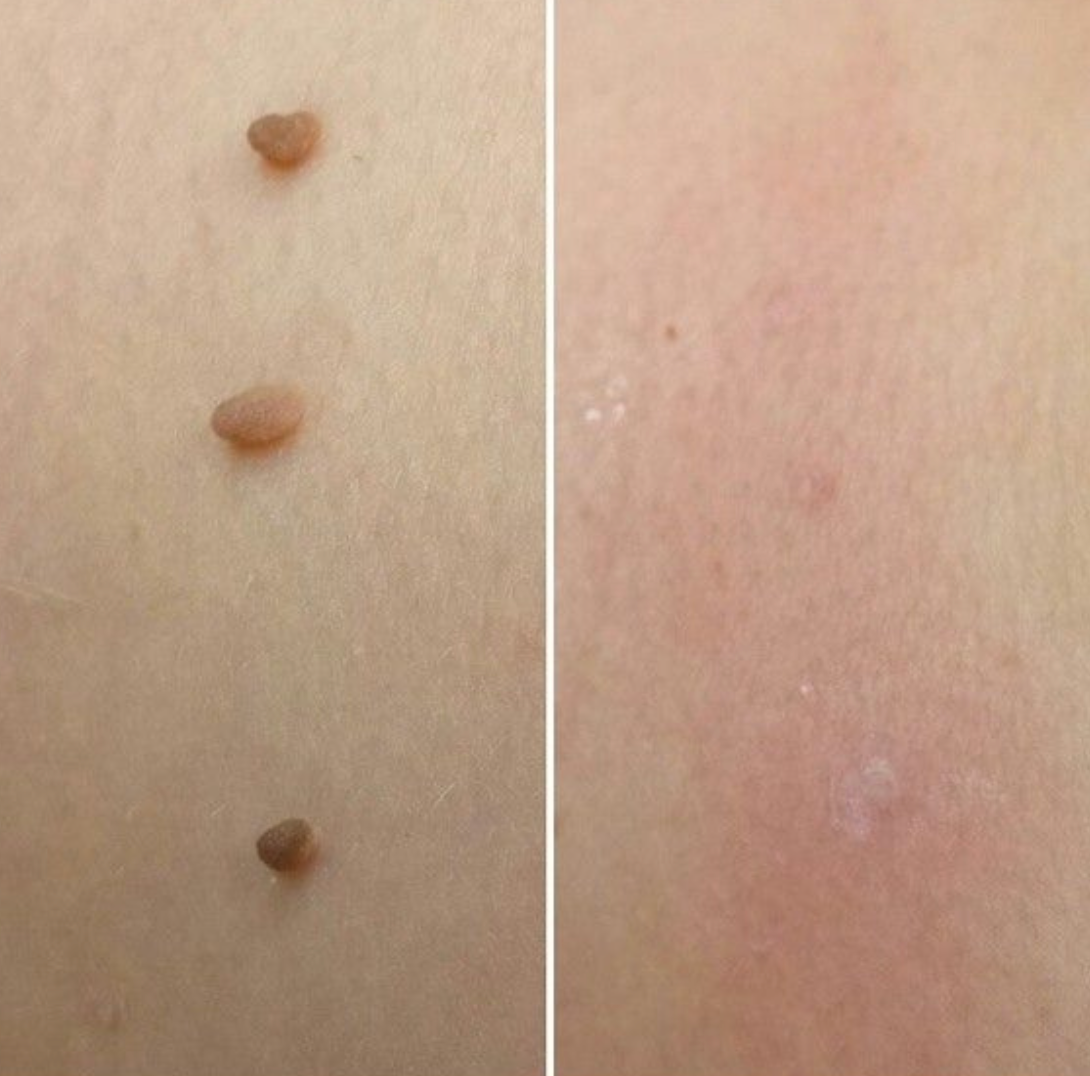 Skin Tag Removal Kit