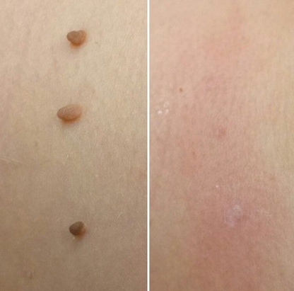 Skin Tag Removal Kit