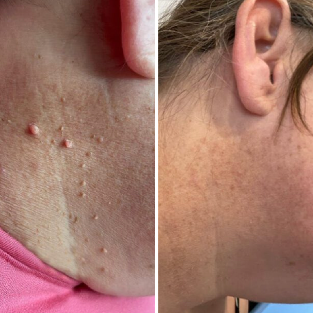 Skin Tag Removal Kit