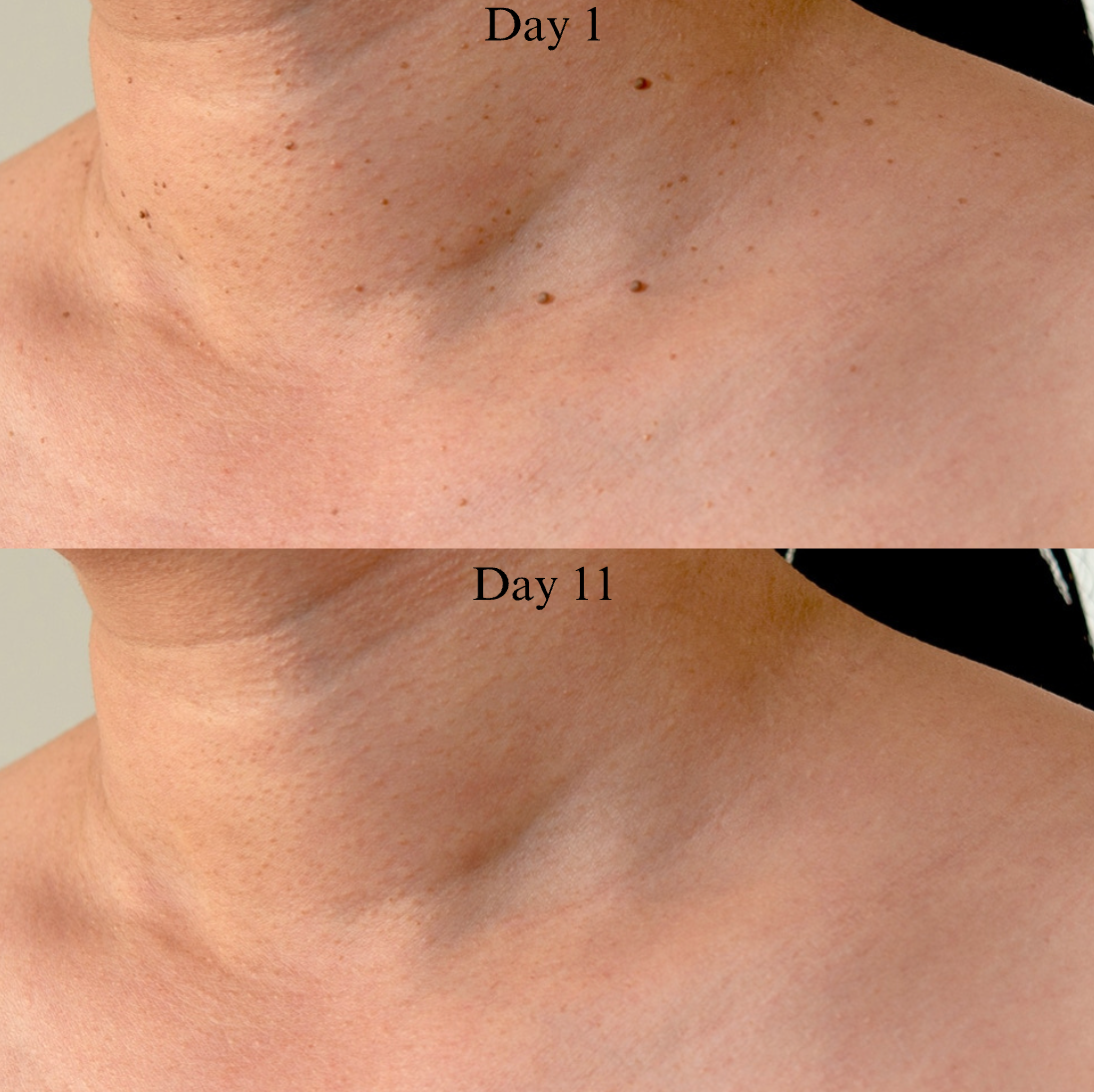 Skin Tag Removal Kit