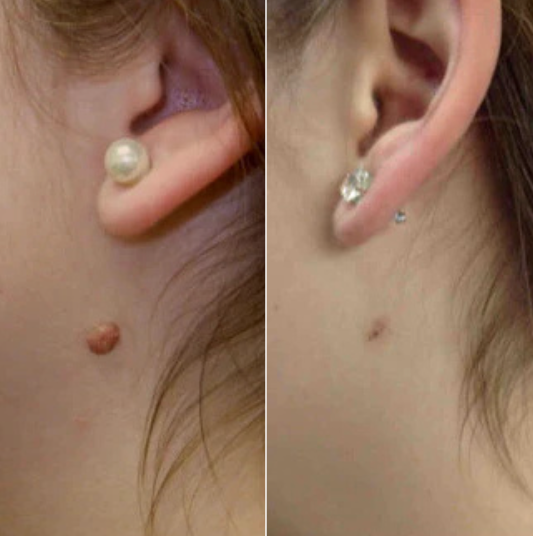 Skin Tag Removal Kit